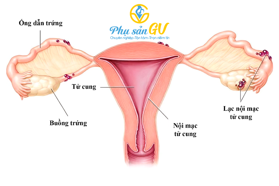 Lạc nội mạc tử cung