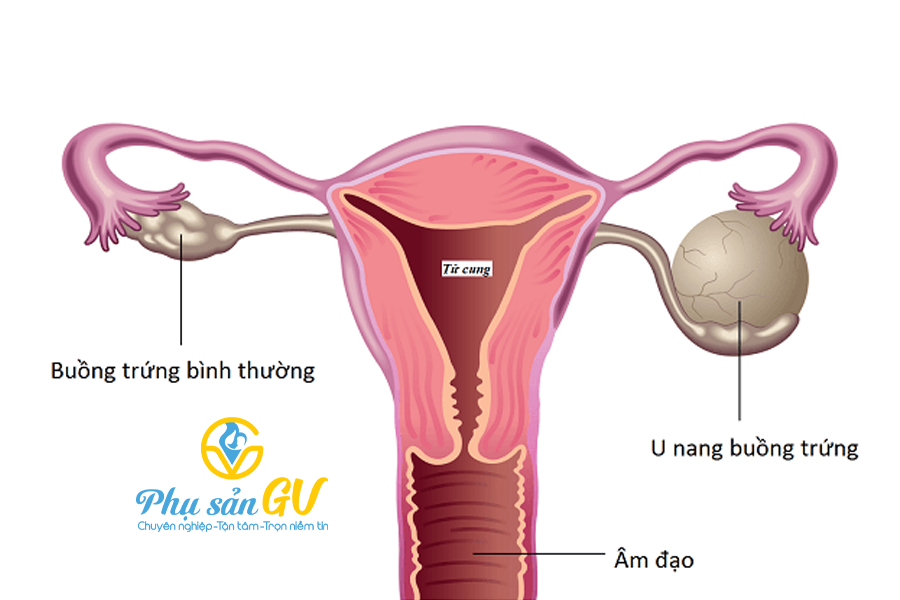 U nang buồng trứng