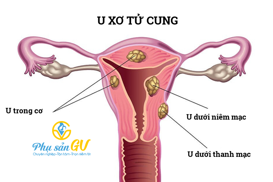 U xơ tử cung