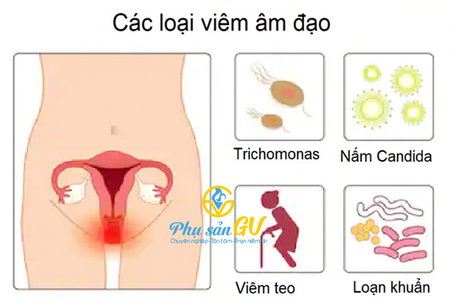 Các thể viêm âm đạo phổ biến hiện nay?