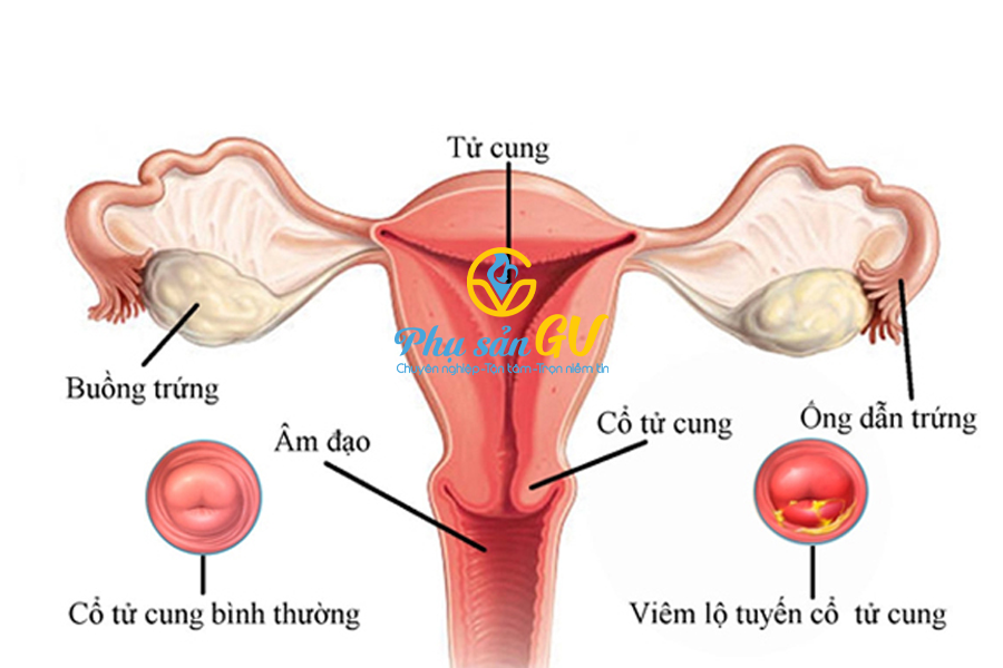 Viêm lộ tuyến cổ tử cung