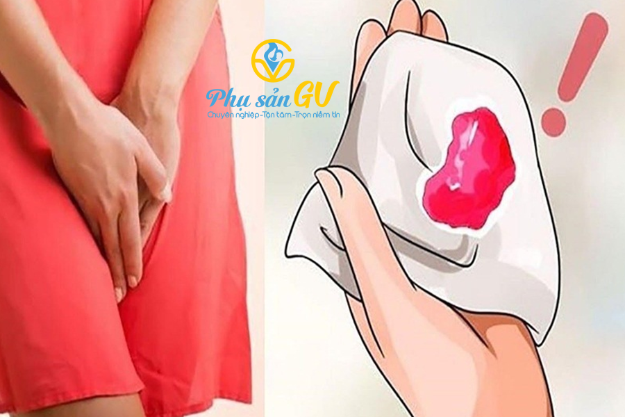 Ra huyết sau khi đi vệ sinh trong quá trình đặt thuốc điều trị viêm lộ tuyến cổ tử cung có sao không?