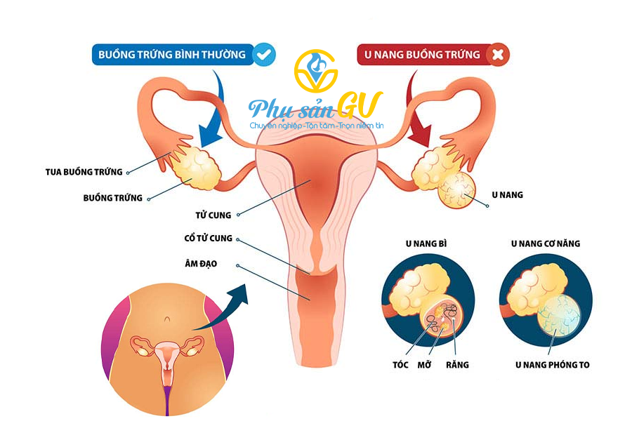 U nang buồng trứng là gì? Phân loại, dấu hiệu nhận biết và nguyên nhân gây bệnh